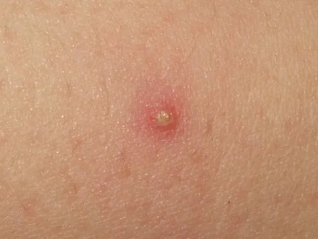 A single small pustule with a yellow head and a ring of redness on otherwise normal pale skin