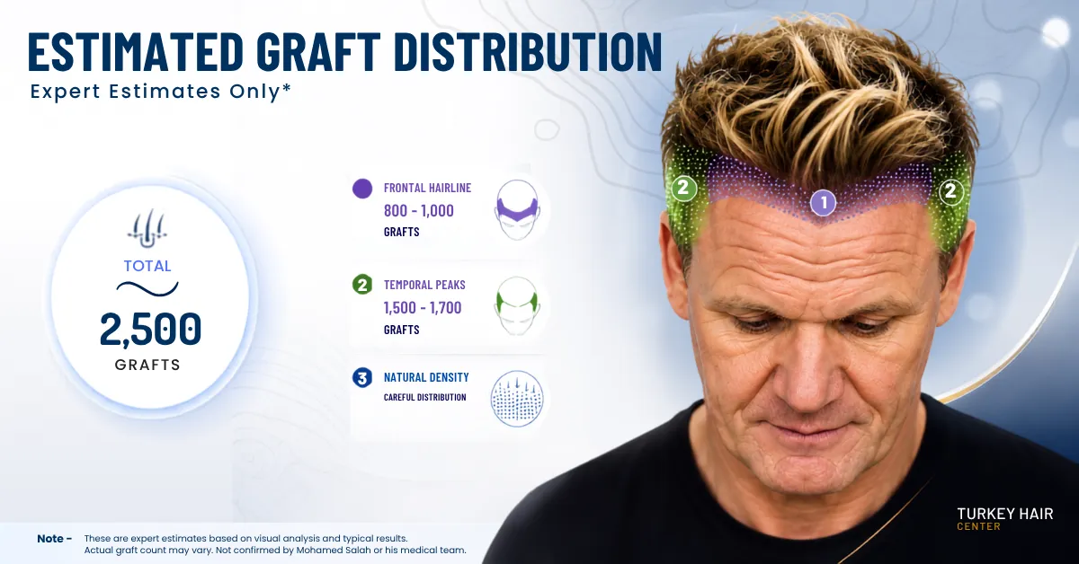 Gordon Ramsay Hair Transplant Did He Get One & What It Cost