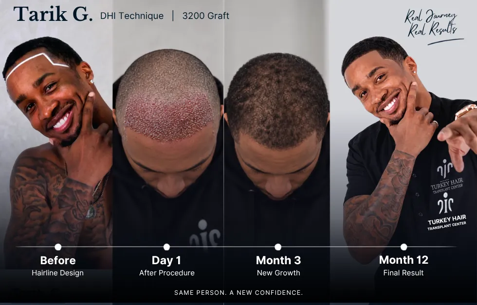hair graft results, hair transplant before after, hair transplant timeline, graft growth timeline, hair restoration results
