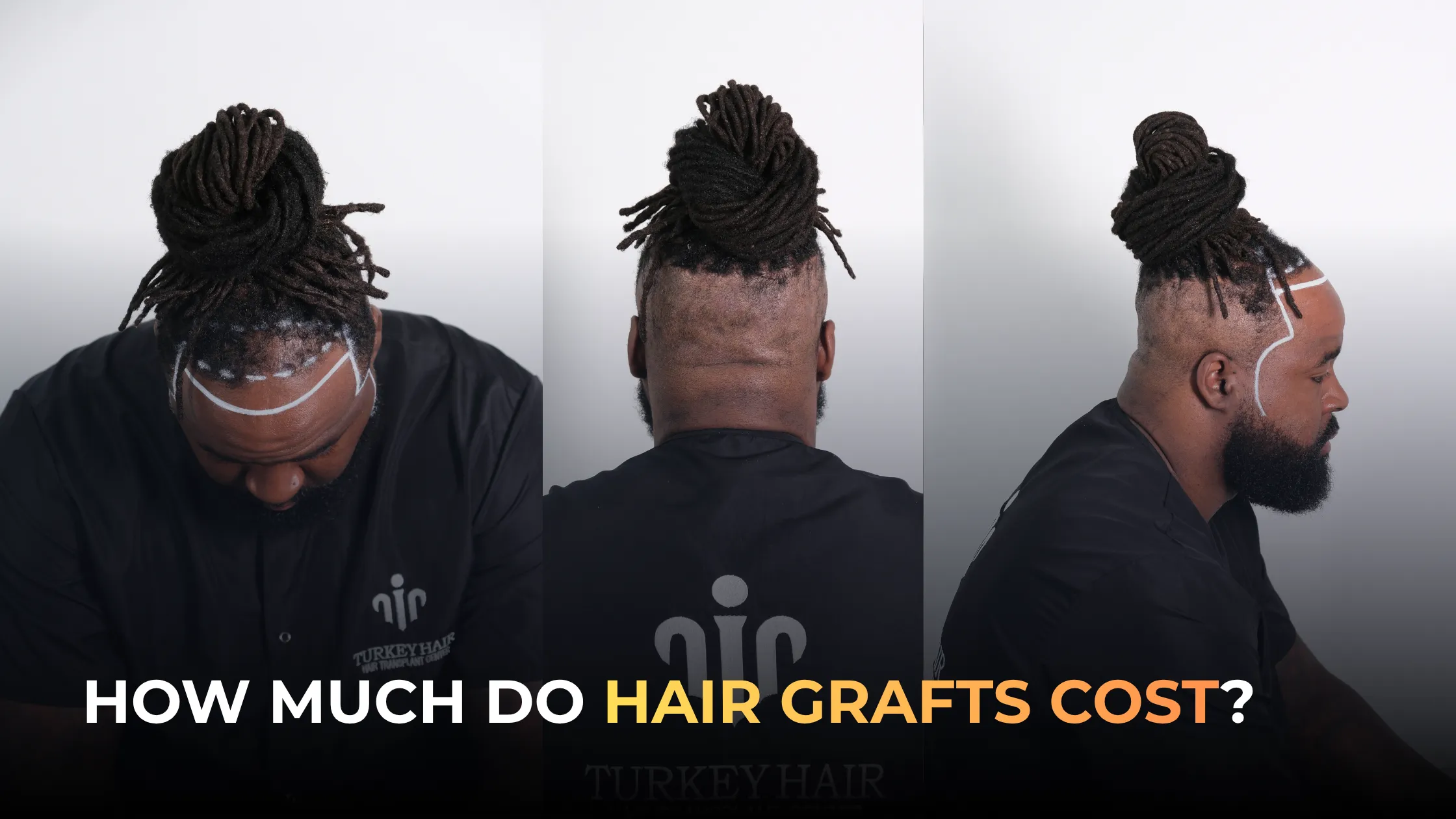 hair graft cost, hair graft consultation, hair transplant planning, graft count estimate, hair restoration cost