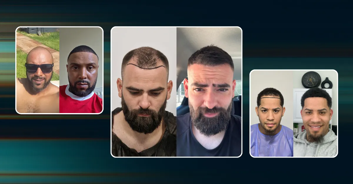 hair implants real results, hair implants before after, natural hair transplant results, hair restoration before after, real hair implant results