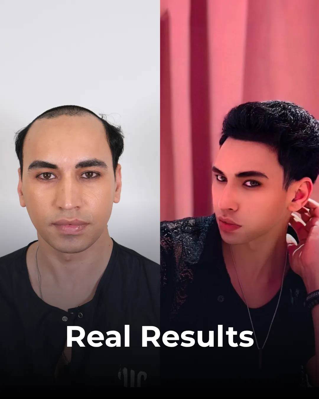 hair implants real results, hair implants before after, natural hair transplant results, hair restoration before after, real hair implant results