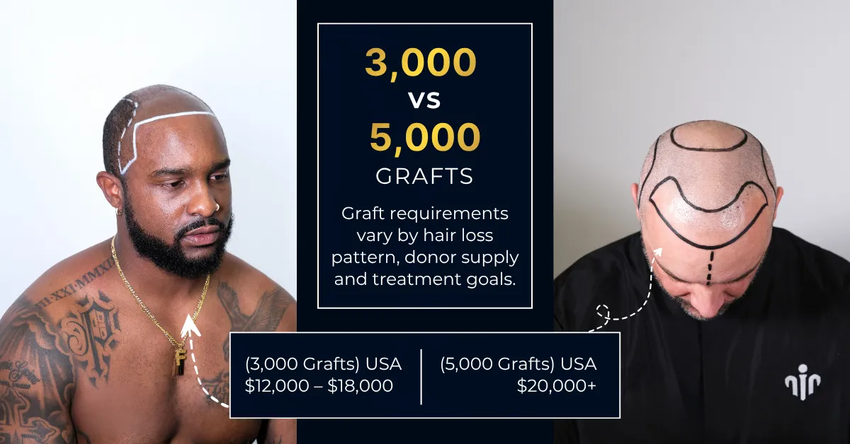 coût des implants capillaires, coût de 3000 greffons, greffe de cheveux de 5000 greffons, prix des greffons capillaires, greffe de cheveux en grande séance