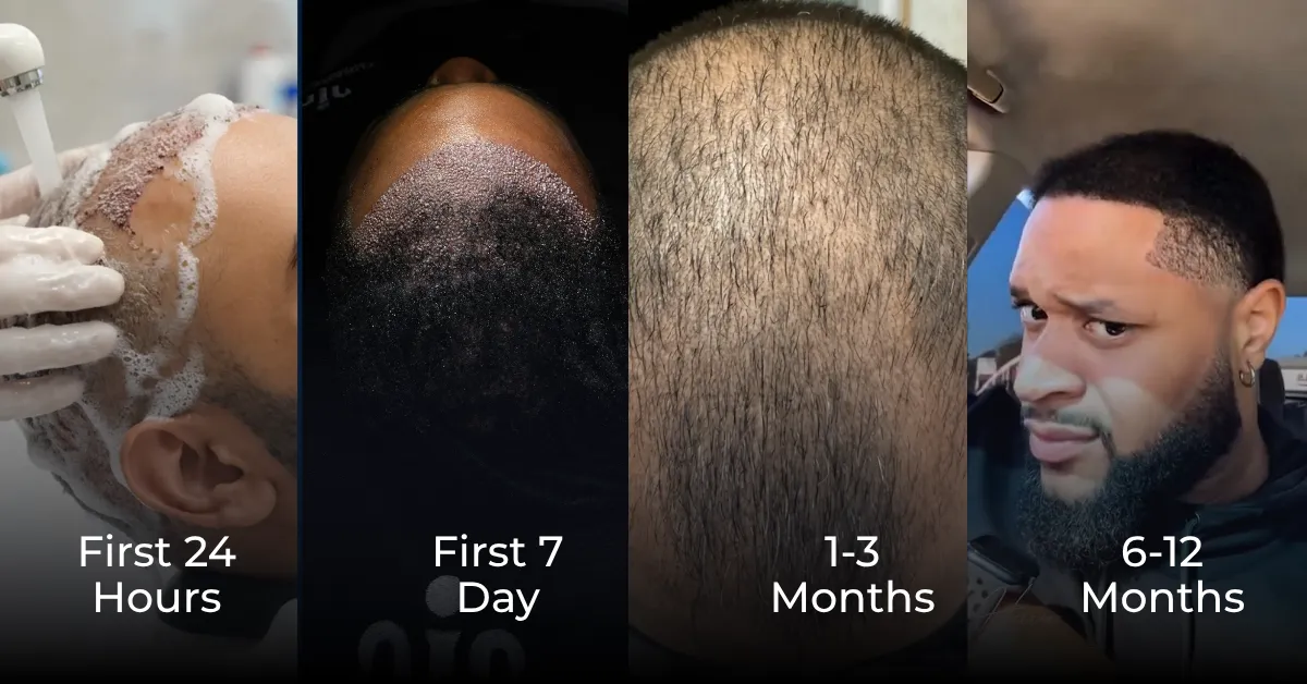 How Much Is Hair Replacement? Turkey Cost, Grafts, Packages & Results