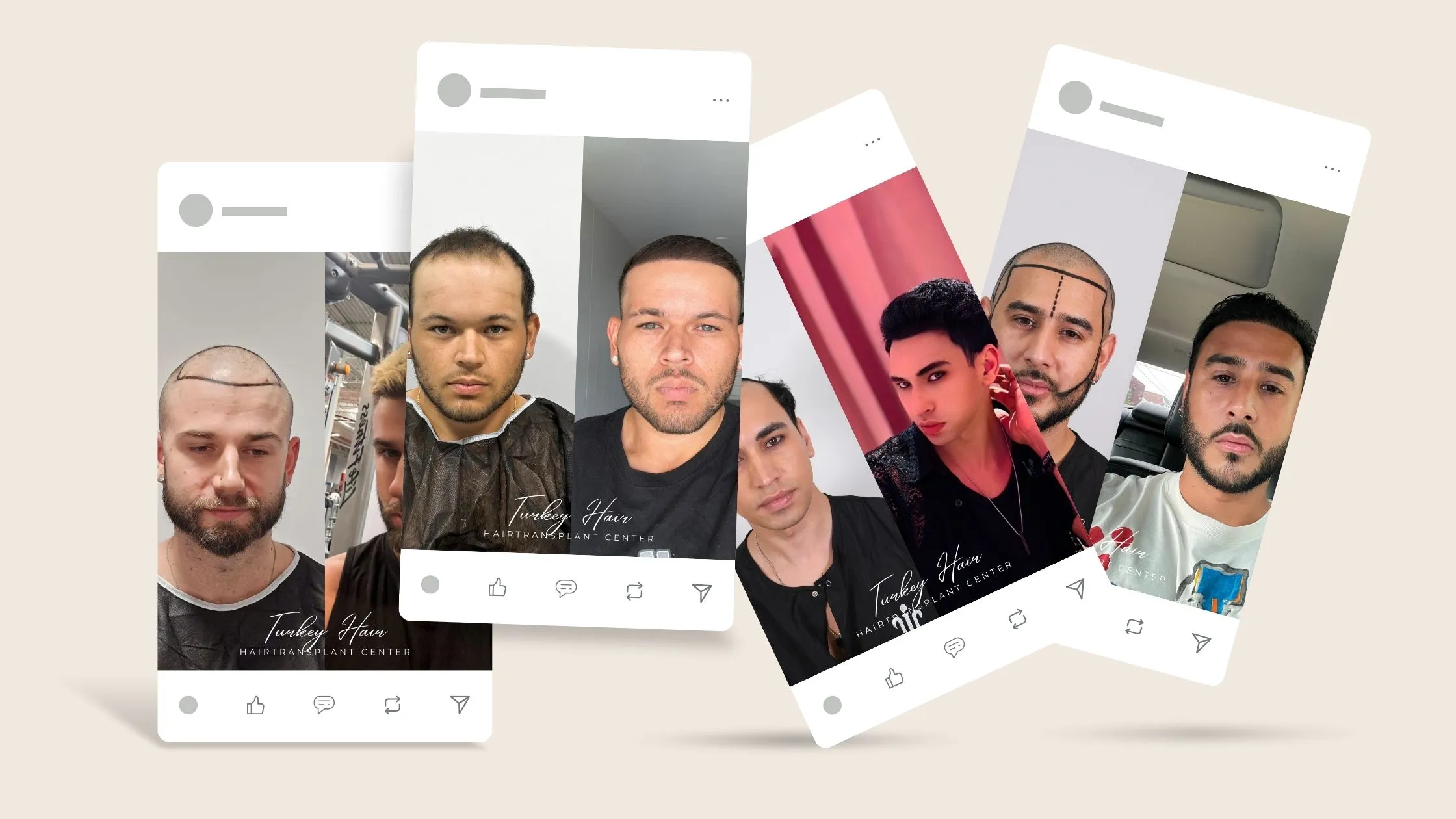 Hair Transplant Cost in Turkey 2026: Grafts, Packages, Hidden Fees and Real Budget
