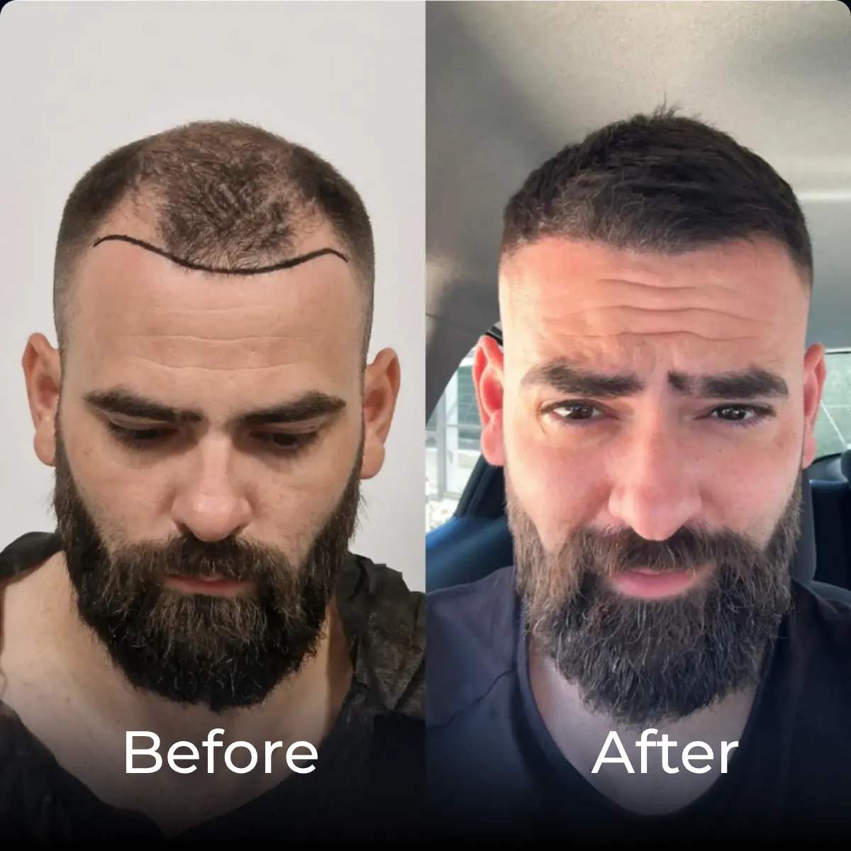 hair transplant before after, hair transplant work recovery, hair transplant results, hair restoration before after