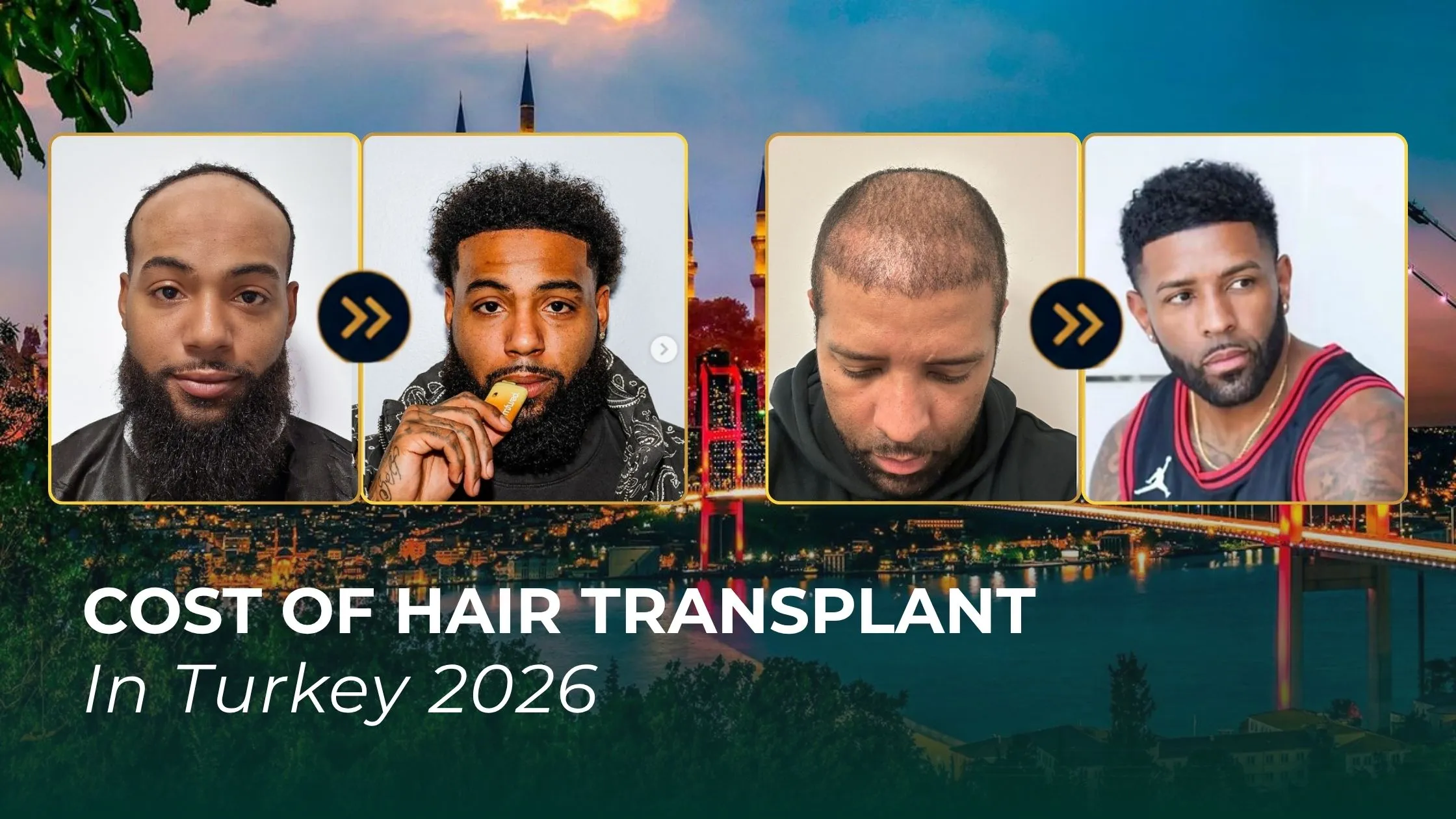 hair transplant cost in Turkey 2026, Turkey hair transplant before after, celebrity hair transplant cost, Turkey hair transplant introduction, 2026 hair transplant prices, hairline restoration cost, graft cost Turkey, hair transplant comparison, hair restoration Turkey, hair transplant results
