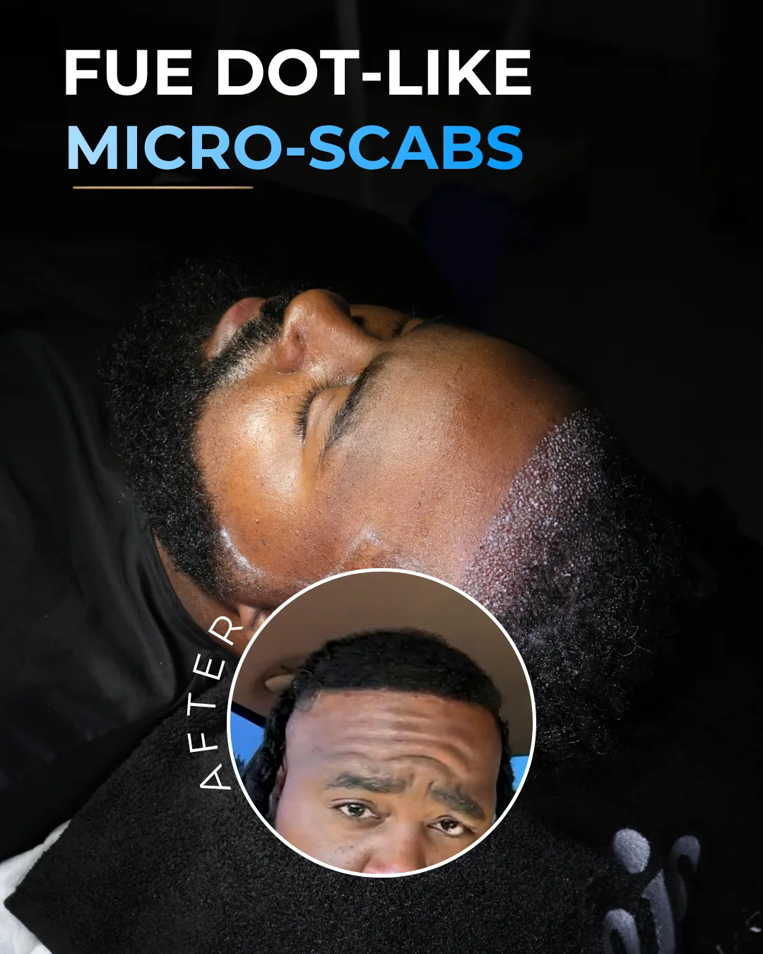 Hair transplant micro scabs, tiny scabs after hair transplant, micro scabbing after hair transplant, hair transplant healing