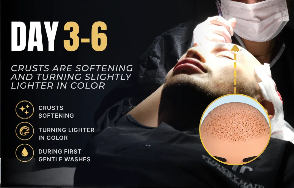 Hair transplant day 3, hair transplant day 4, hair transplant day 6, hair transplant scabs healing