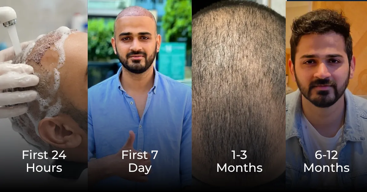 coût-de-la-greffe-de-cheveux-par-nombre-de-greffons