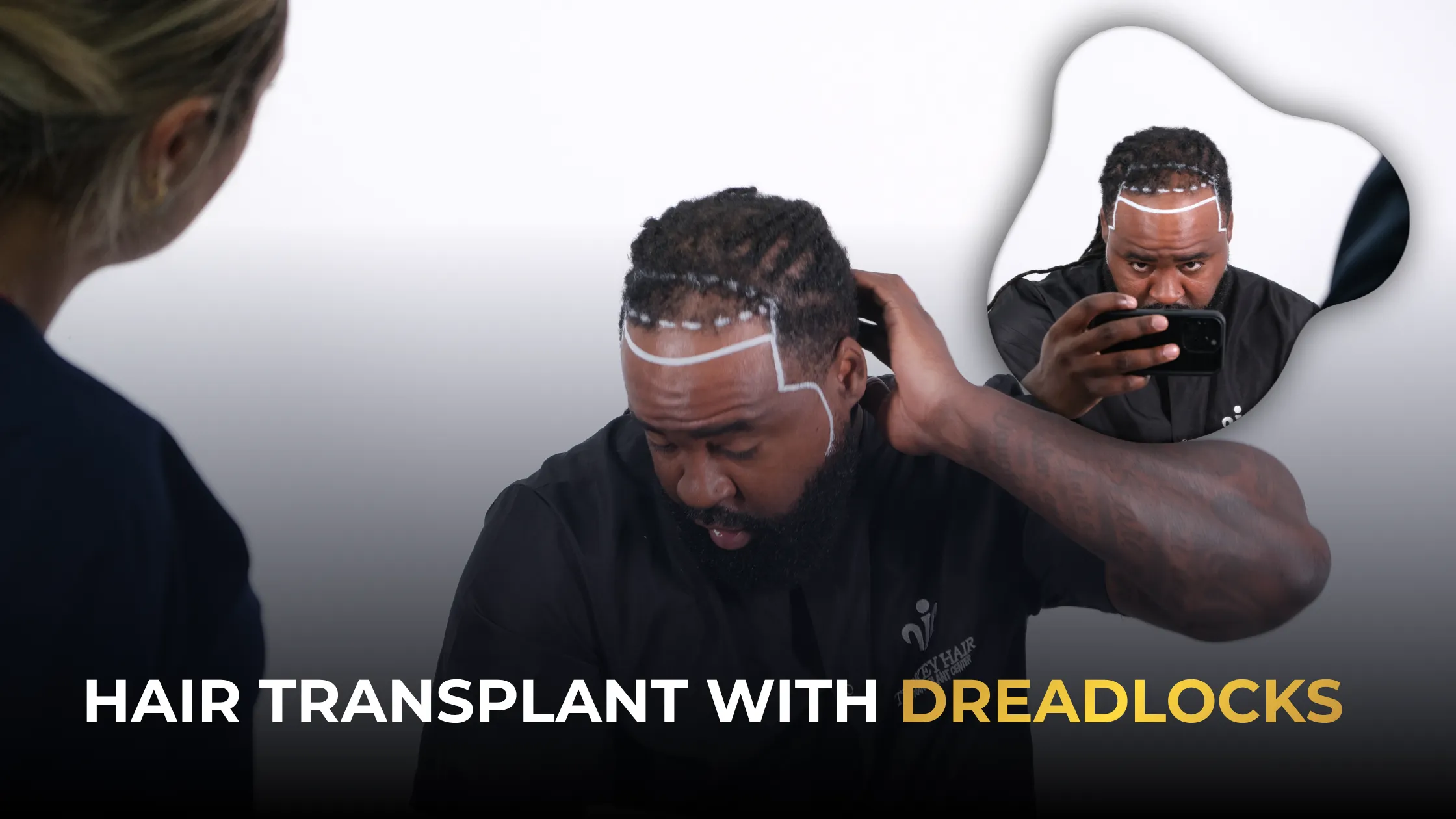 hair transplant with dreadlocks, dreadlock hair restoration, Afro textured hair transplant, dreadlocks transplant guide