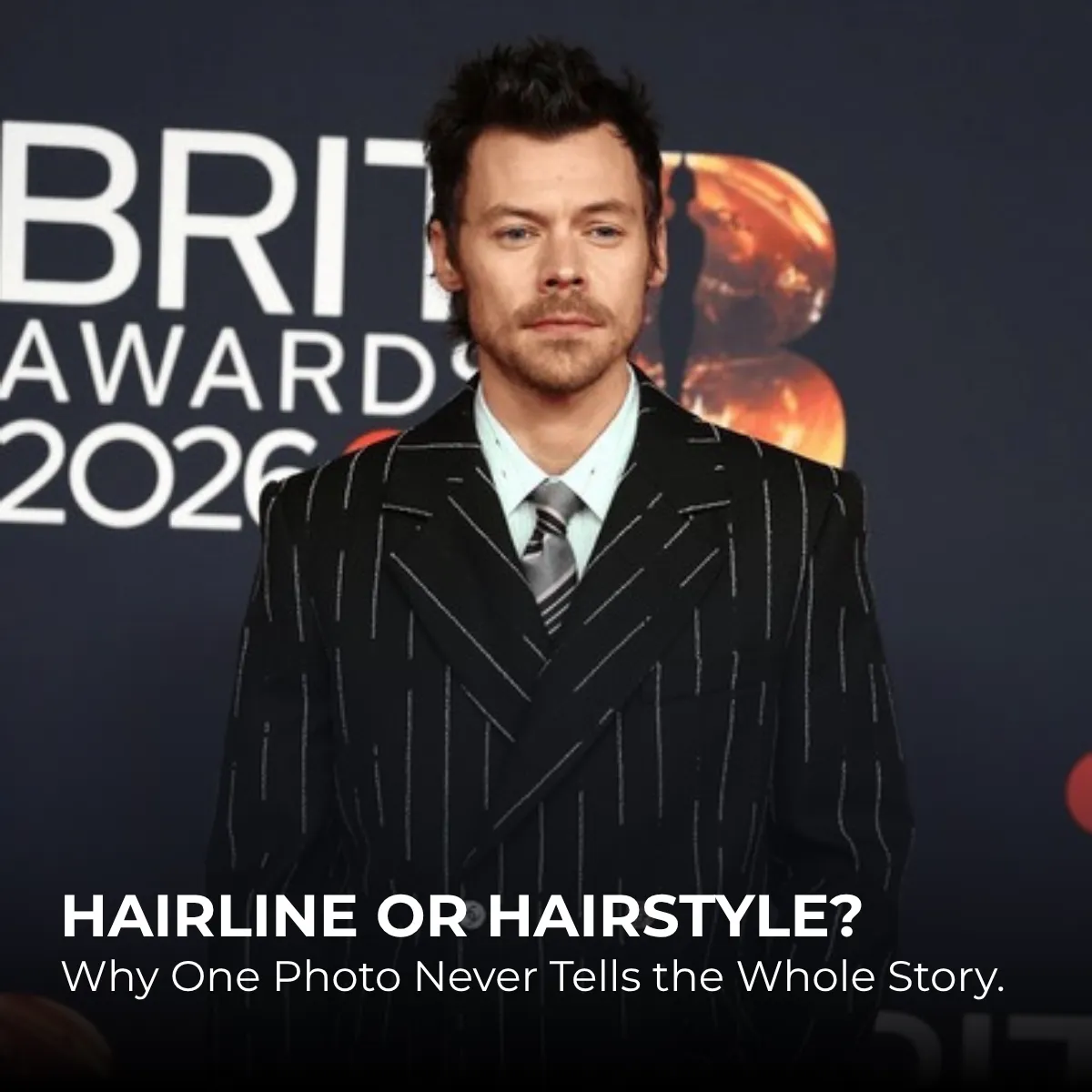 Harry Styles Hair Transplant: Rumors, Hairline & Photos