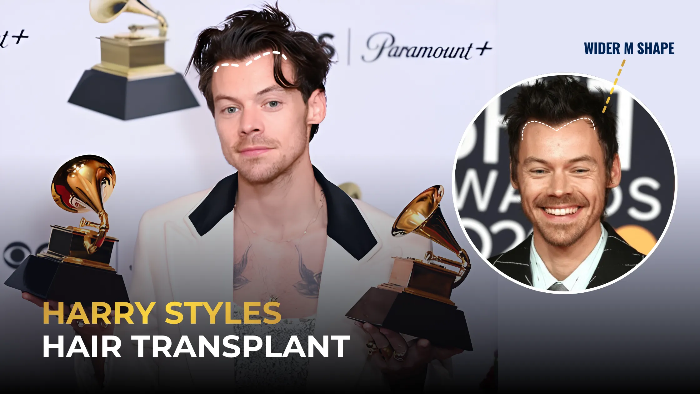 Harry Styles Hair Transplant: Rumors, Hairline & Photos