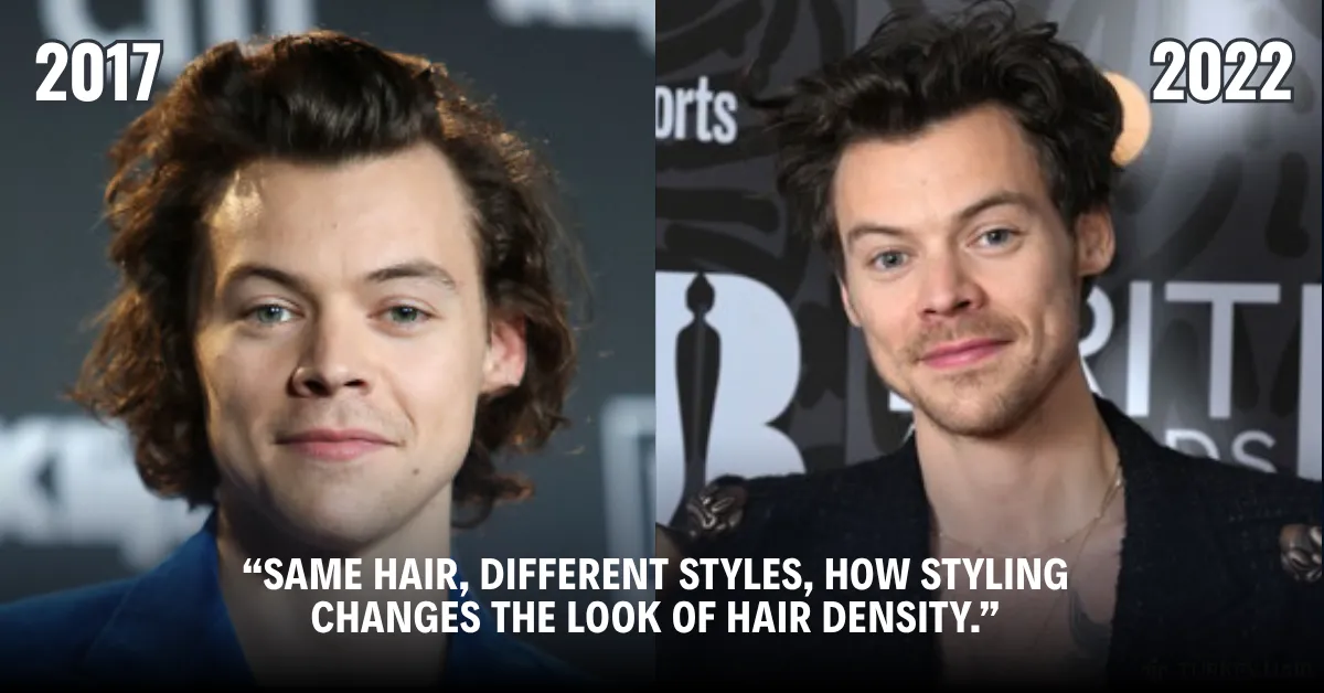 Harry Styles Hair Transplant: Rumors, Hairline & Photos