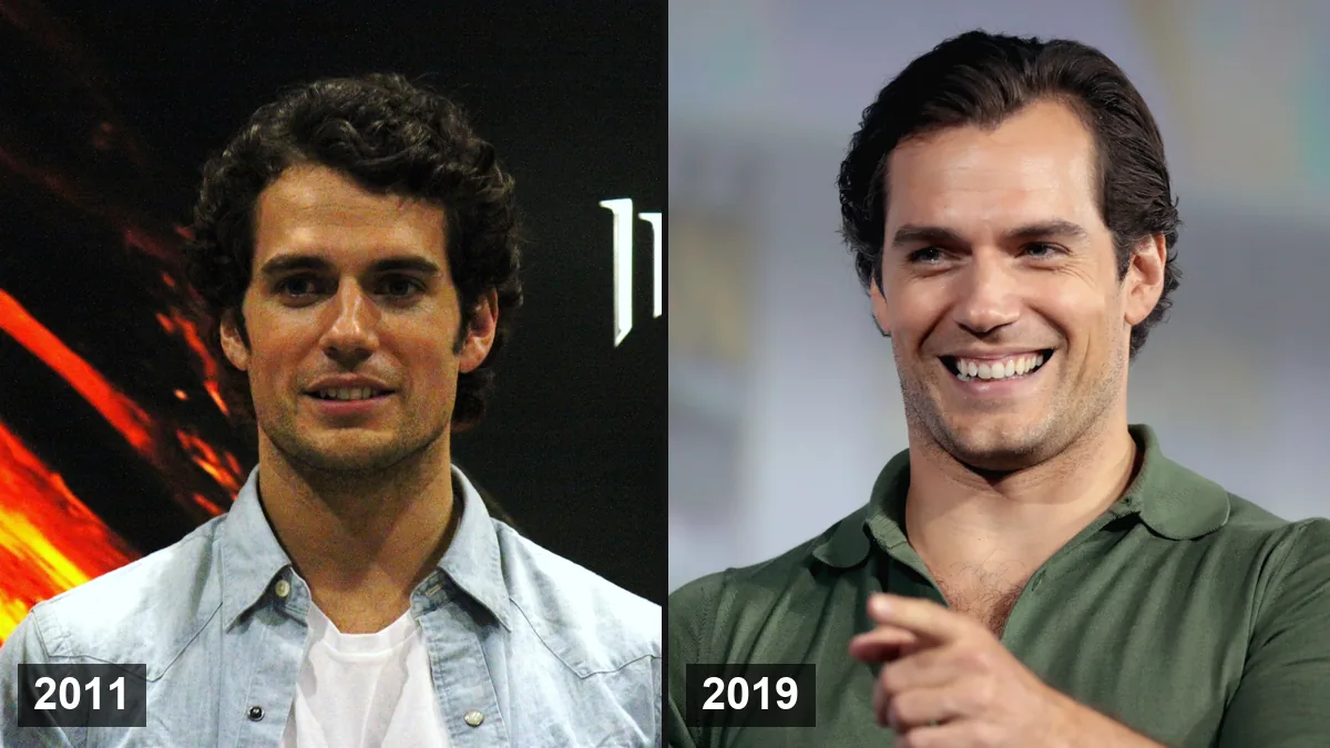 Henry Cavill: évolution de sa ligne capillaire et rumeurs de greffe de cheveux expliquées Hair Transplant hair transplant analysis