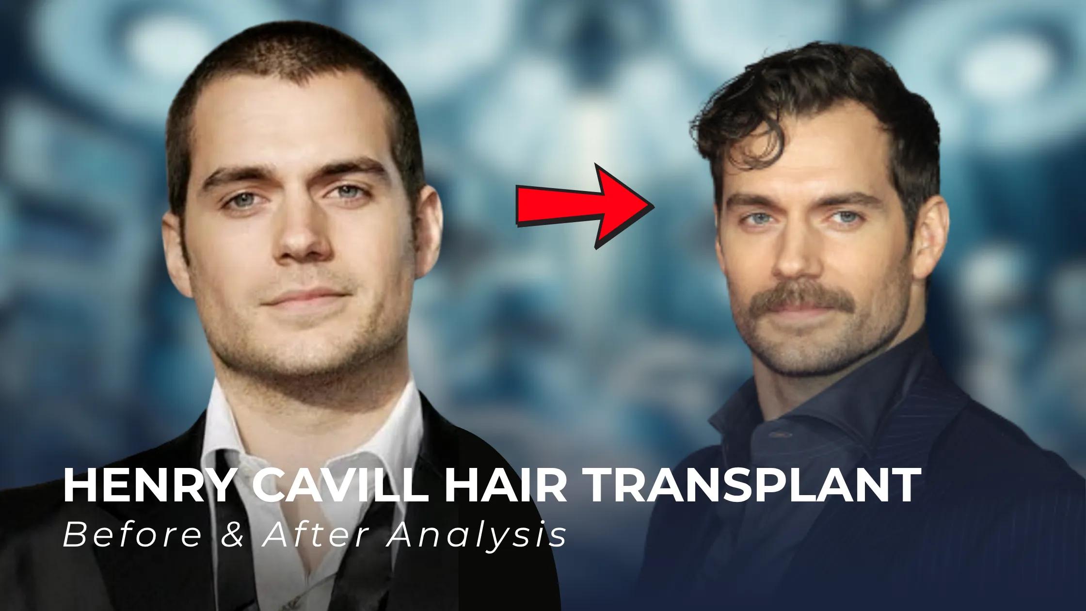 Henry Cavill hair transplant, Henry Cavill before after, Henry Cavill hairline analysis, celebrity hair transplant, hair transplant rumors, mature hairline