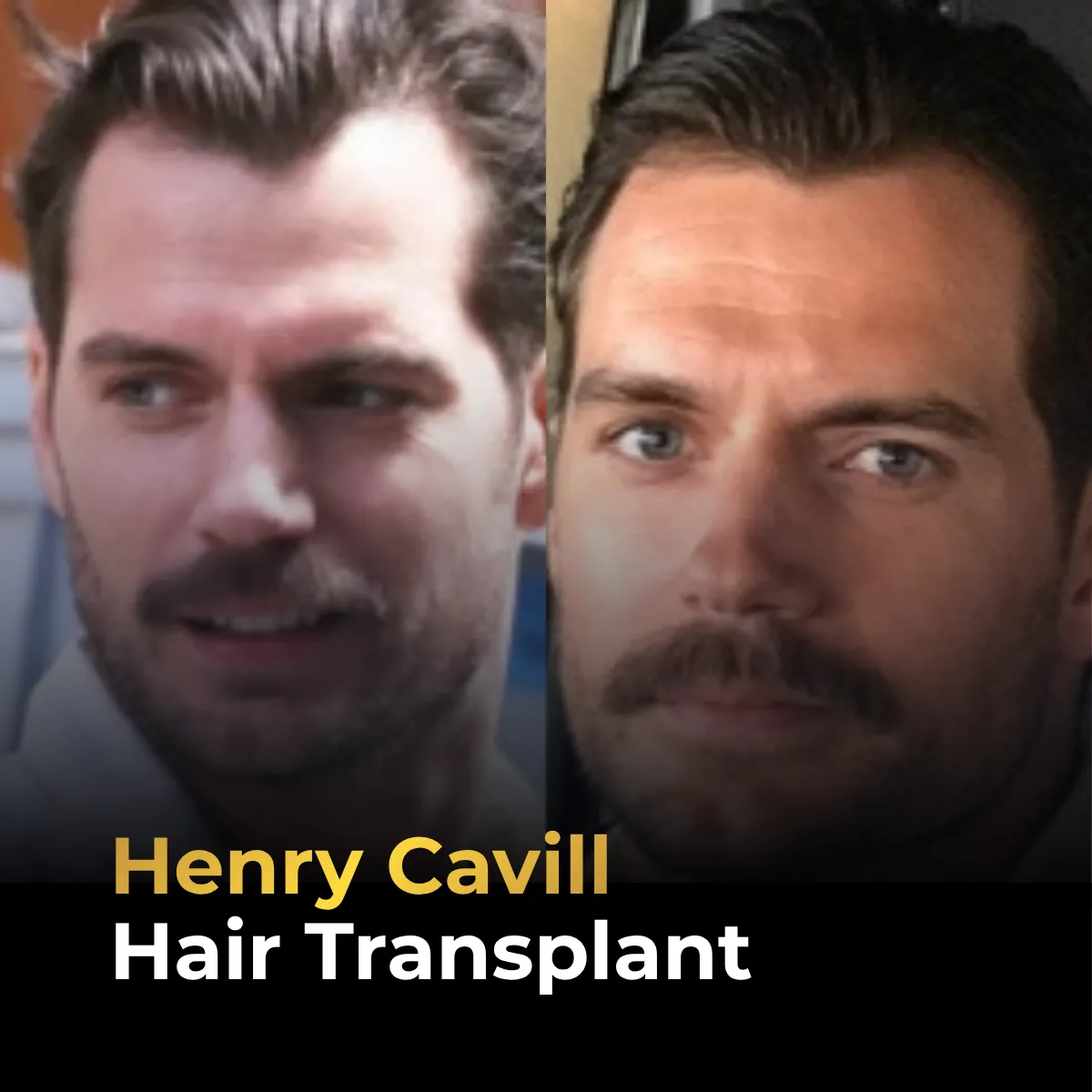 Henry Cavill hairline analysis, Henry Cavill hair transplant, Henry Cavill temporal peaks, mature hairline analysis, celebrity hair transplant, hair restoration rumors