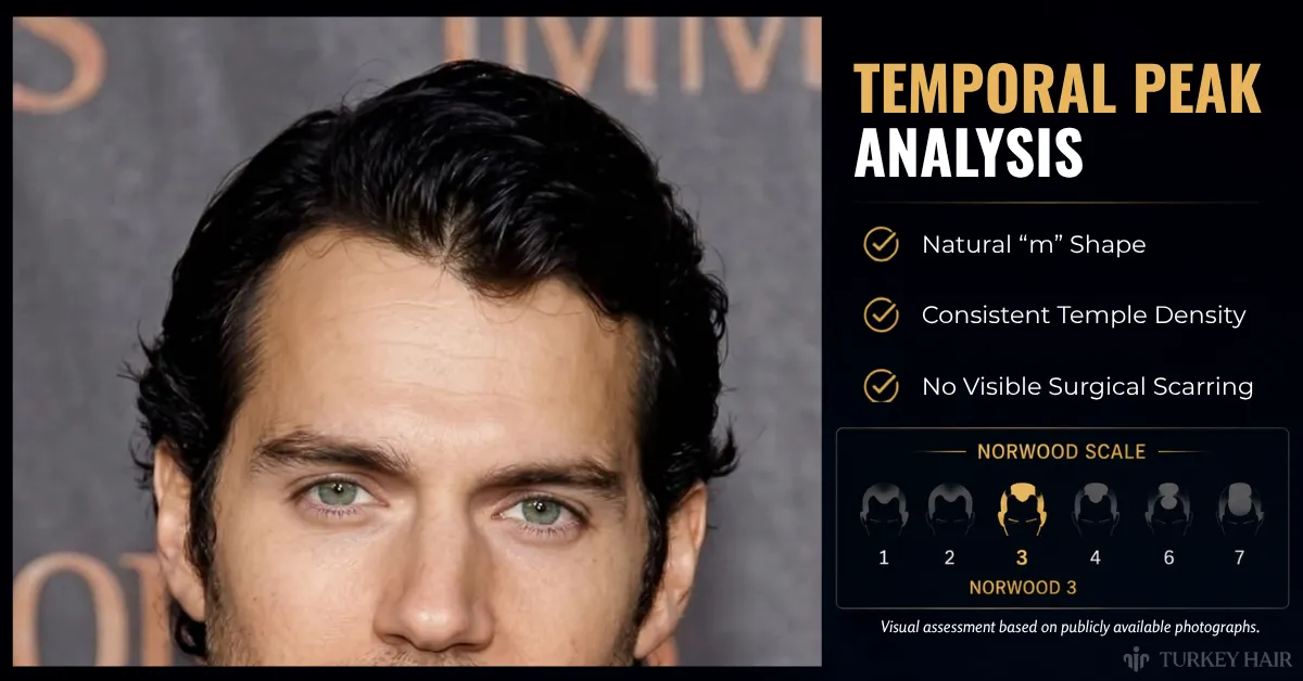 Henry Cavill Hair Transplant: Hairline Evolution & Rumors Explained