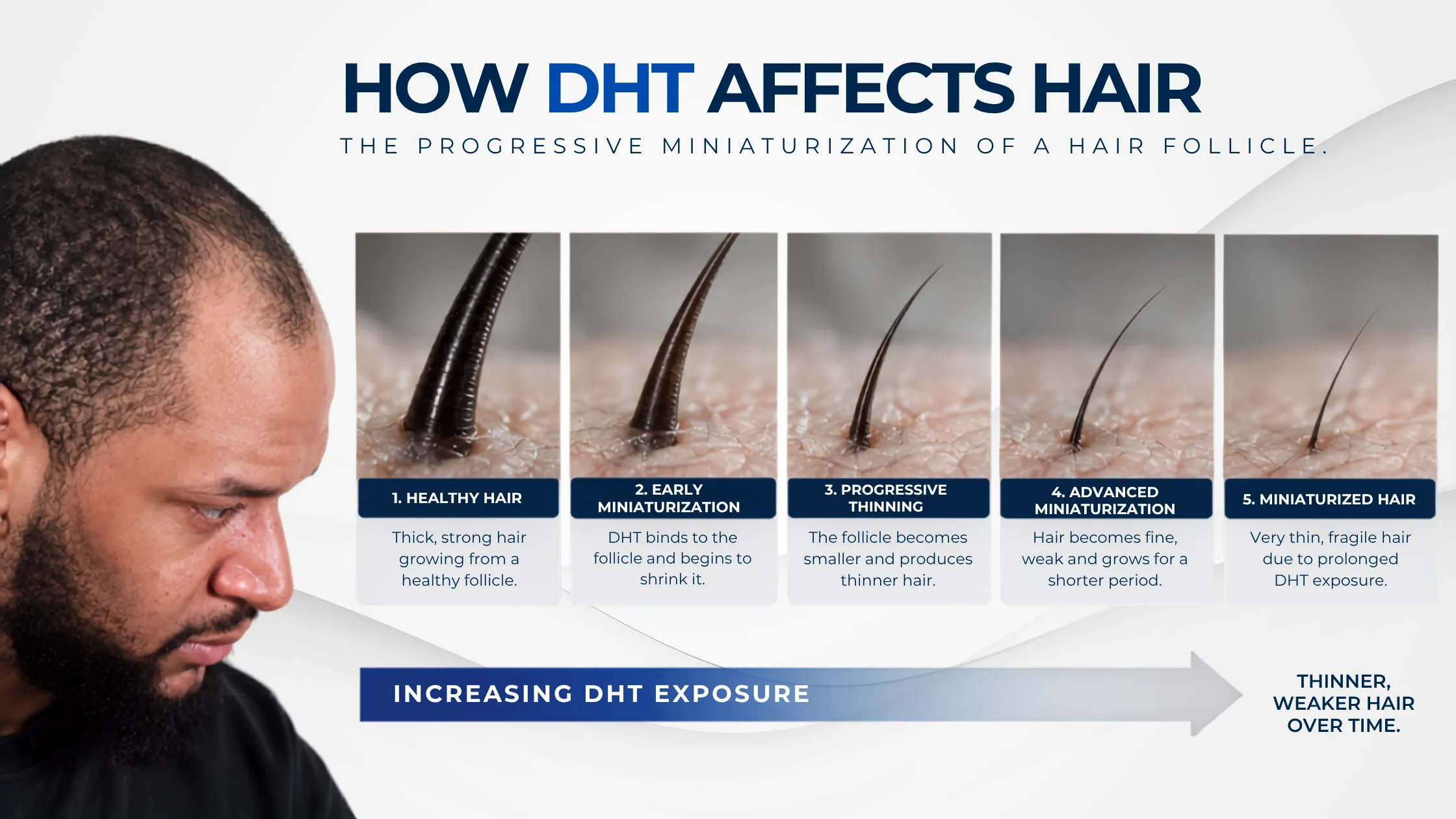 how DHT affects hair, DHT hair follicles, follicle miniaturization, genetic hair loss