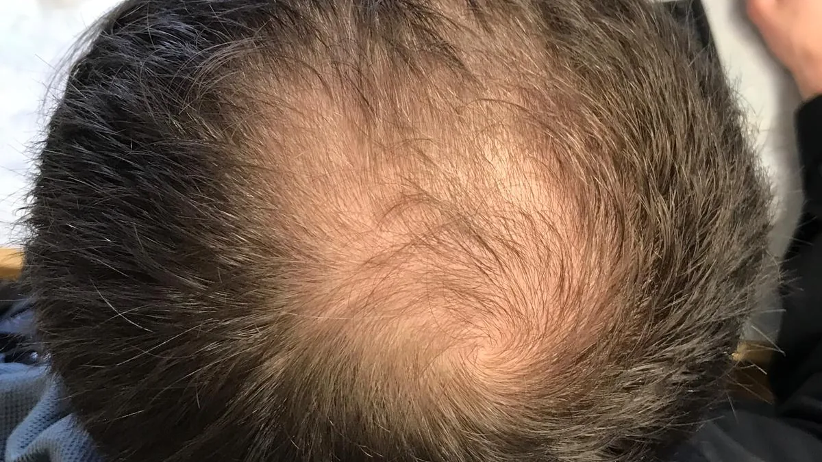 Top-down view of a man's dark hair with a thinning, swirled area at the crown where the scalp shows through