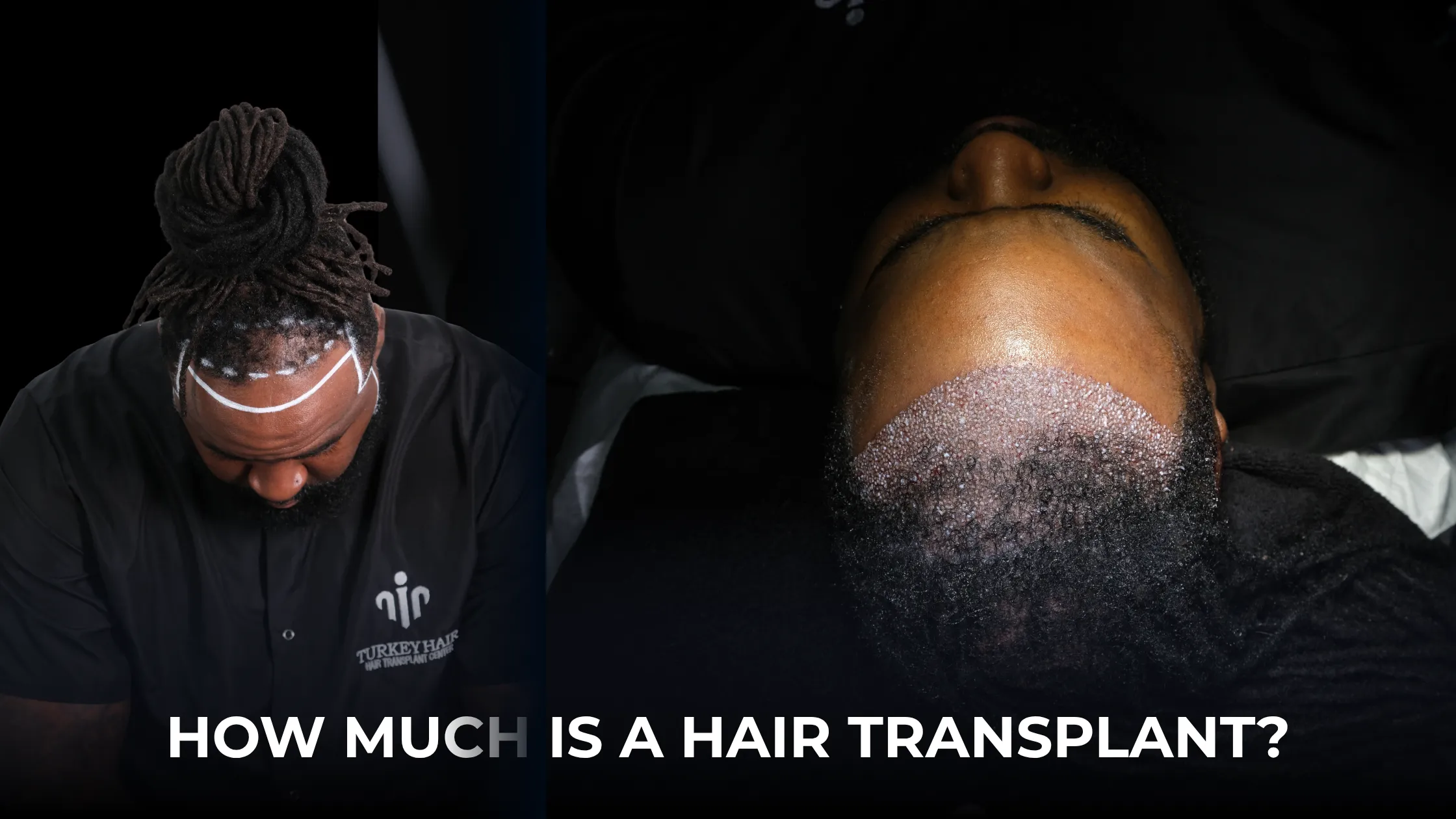 how much is a hair transplant in Turkey, hair transplant price Turkey, Turkey hair transplant cost, average hair transplant cost Turkey, affordable hair transplant Turkey, hair transplant cost guide