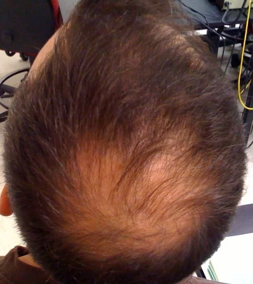 Top of a man's head with thinning hair at the crown