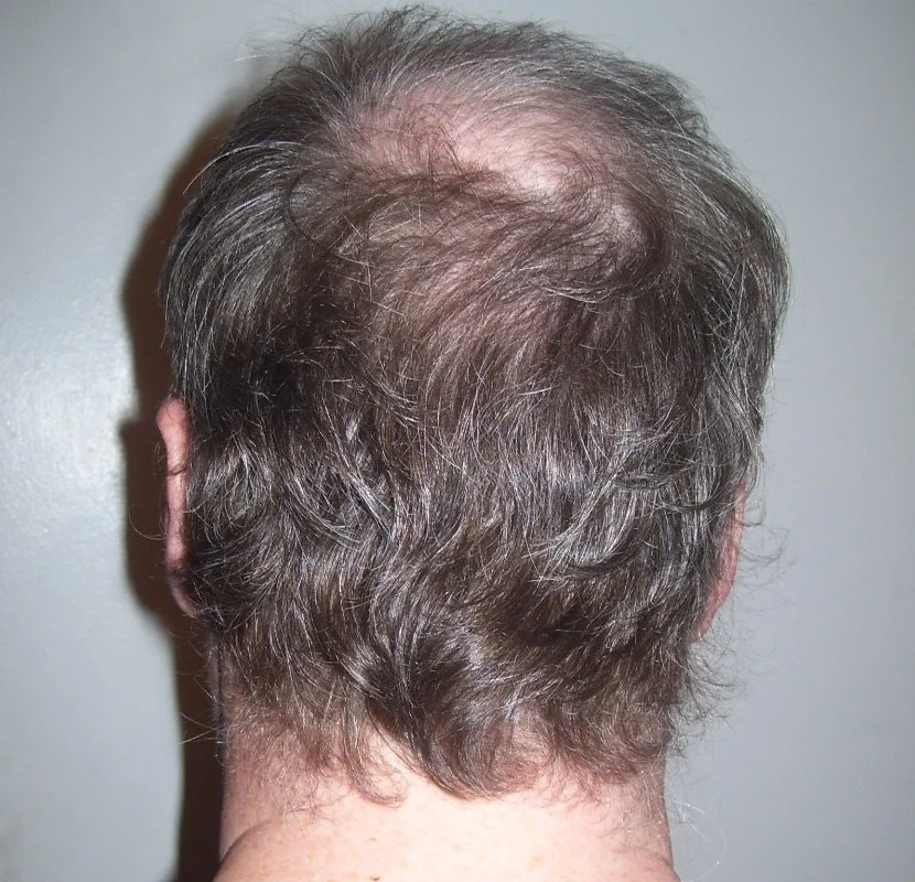 Back of a man's head with a thinning crown and thick hair at the back and sides