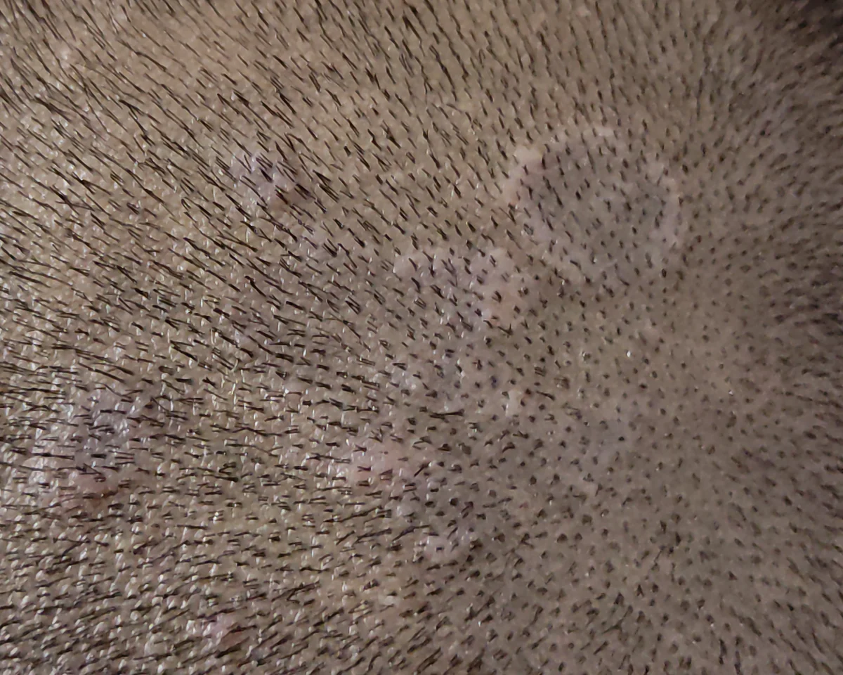 Ring-shaped pale patches of a fungal infection on a closely shaved scalp