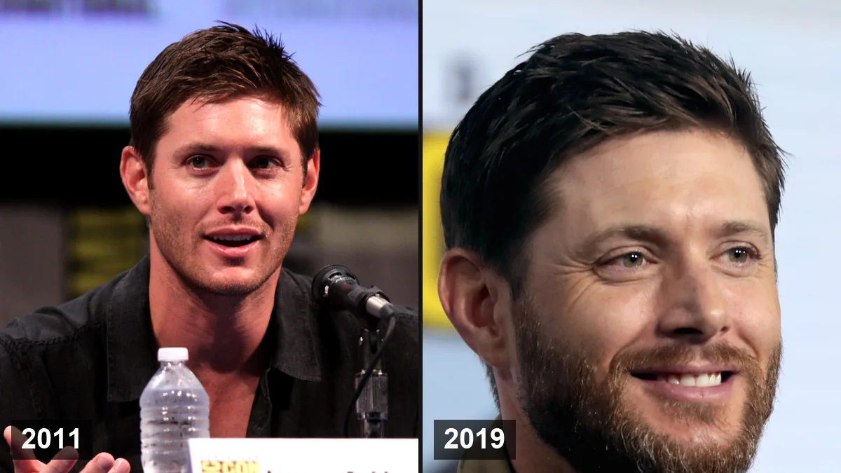 Jensen Ackles Greffe de Cheveux: Rumeurs de Perte de Cheveux et Secrets de Coiffure Hair Transplant hair transplant analysis