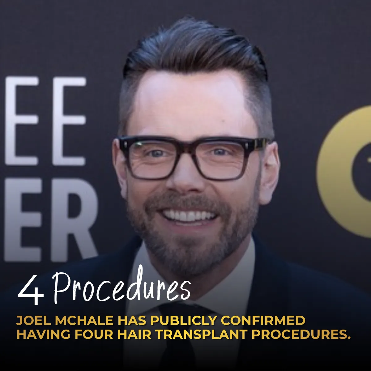 Joel McHale Hair Transplant: 4 Procedures & Results