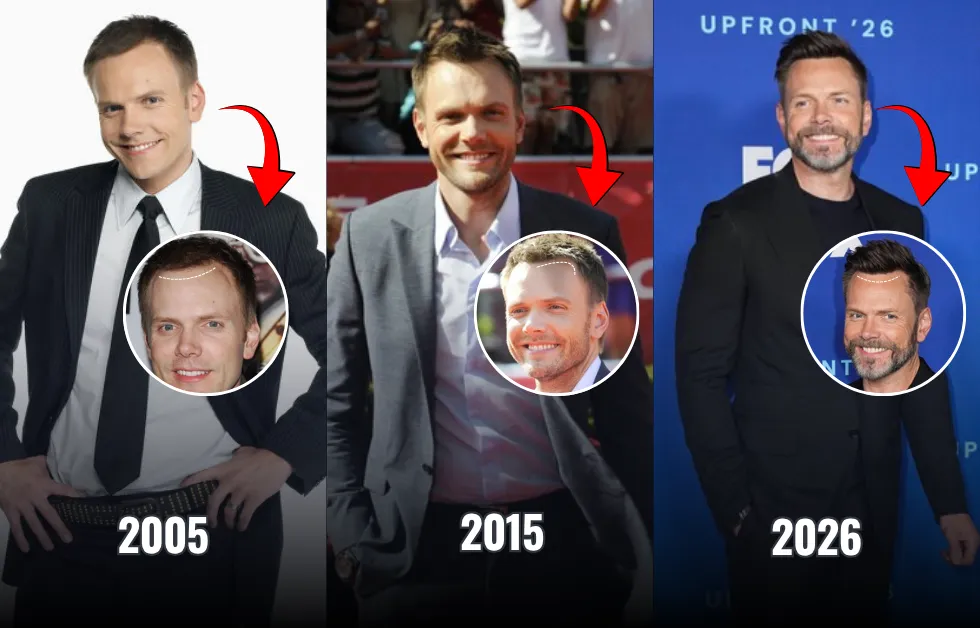 Joel McHale Hair Transplant: 4 Procedures & Results