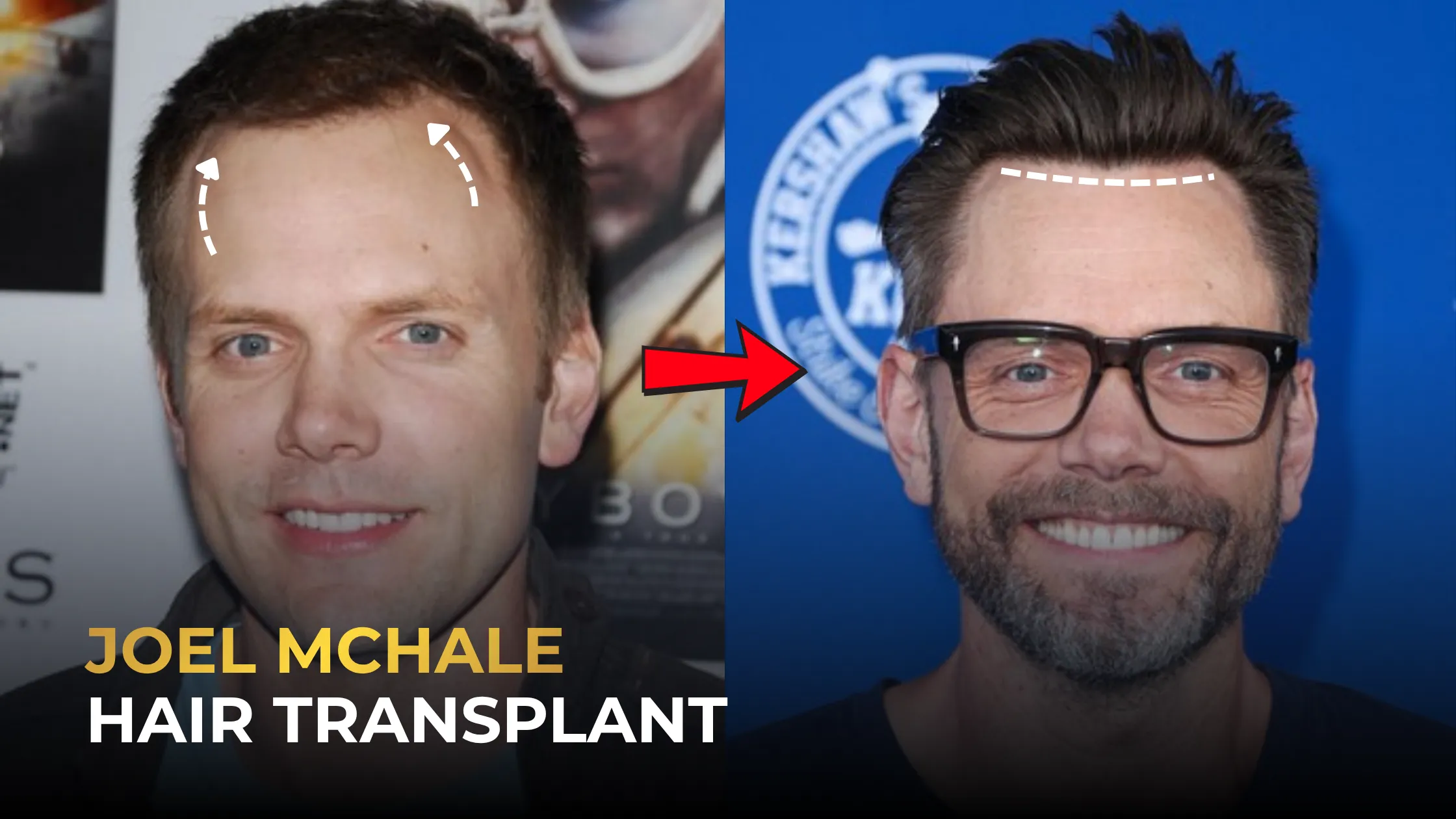 Joel McHale Hair Transplant: 4 Procedures & Results