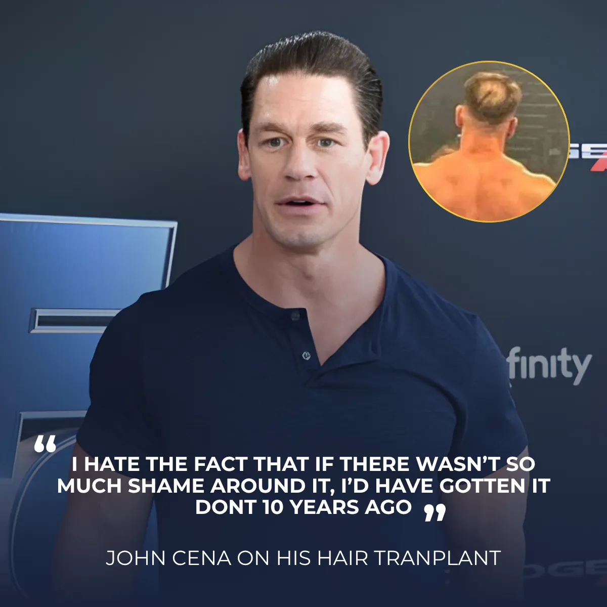 John Cena hair transplant, John Cena hair loss, John Cena hairline analysis, celebrity hair transplant video, hair restoration explanation, hair transplant rumors