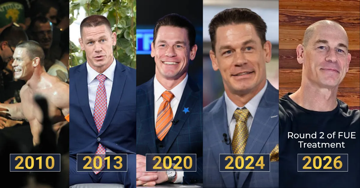 John Cena Hair Transplant: Confirmed Timeline, Before & After Photos, Crown Analysis
