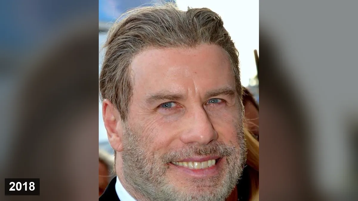 John Travolta: greffe de cheveux ou perruques? Hair Transplant hair transplant analysis