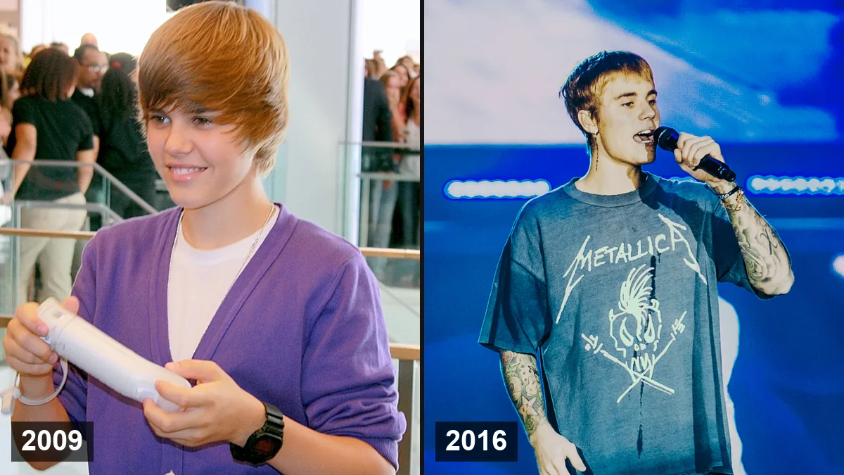 Greffe de cheveux de Justin Bieber: Analyse de la ligne frontale, rumeurs et avis d'experts Hair Transplant hair transplant analysis