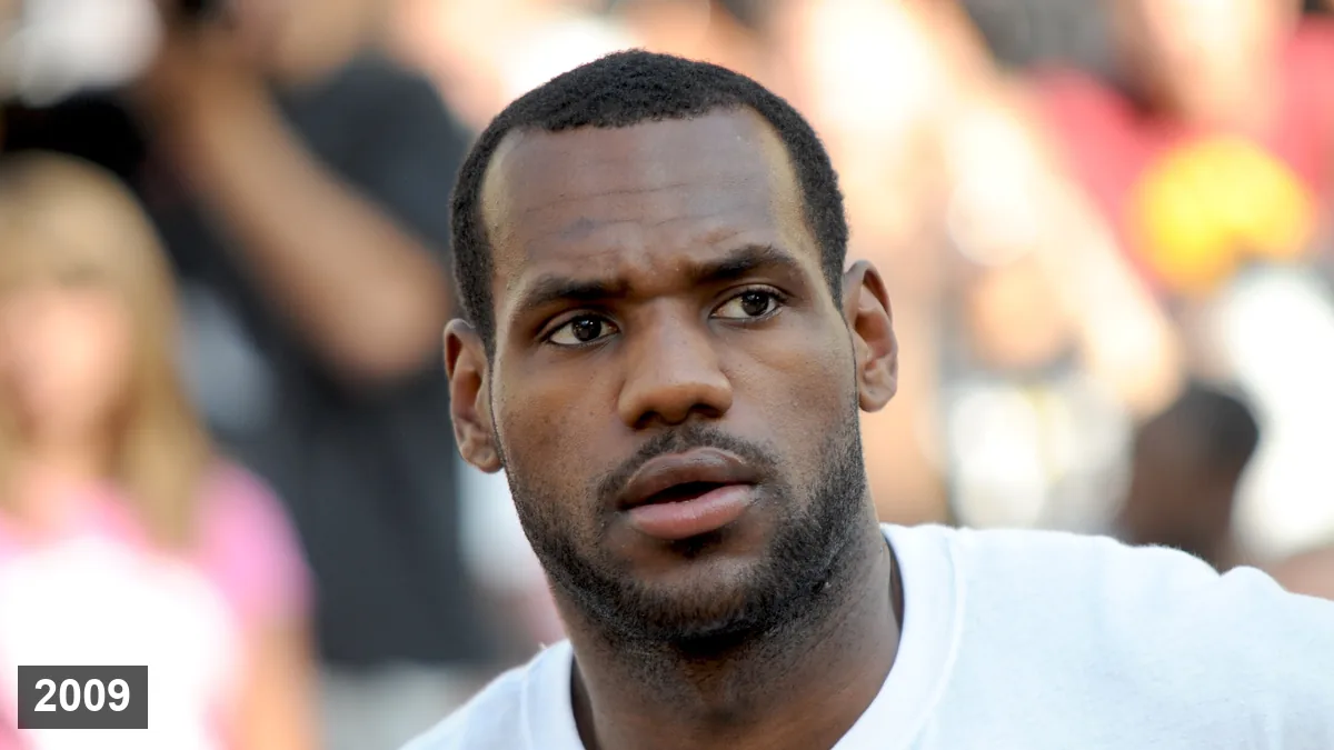 Analyse de la greffe de cheveux de LeBron James: analyse de la ligne frontale Hair Transplant hair transplant analysis