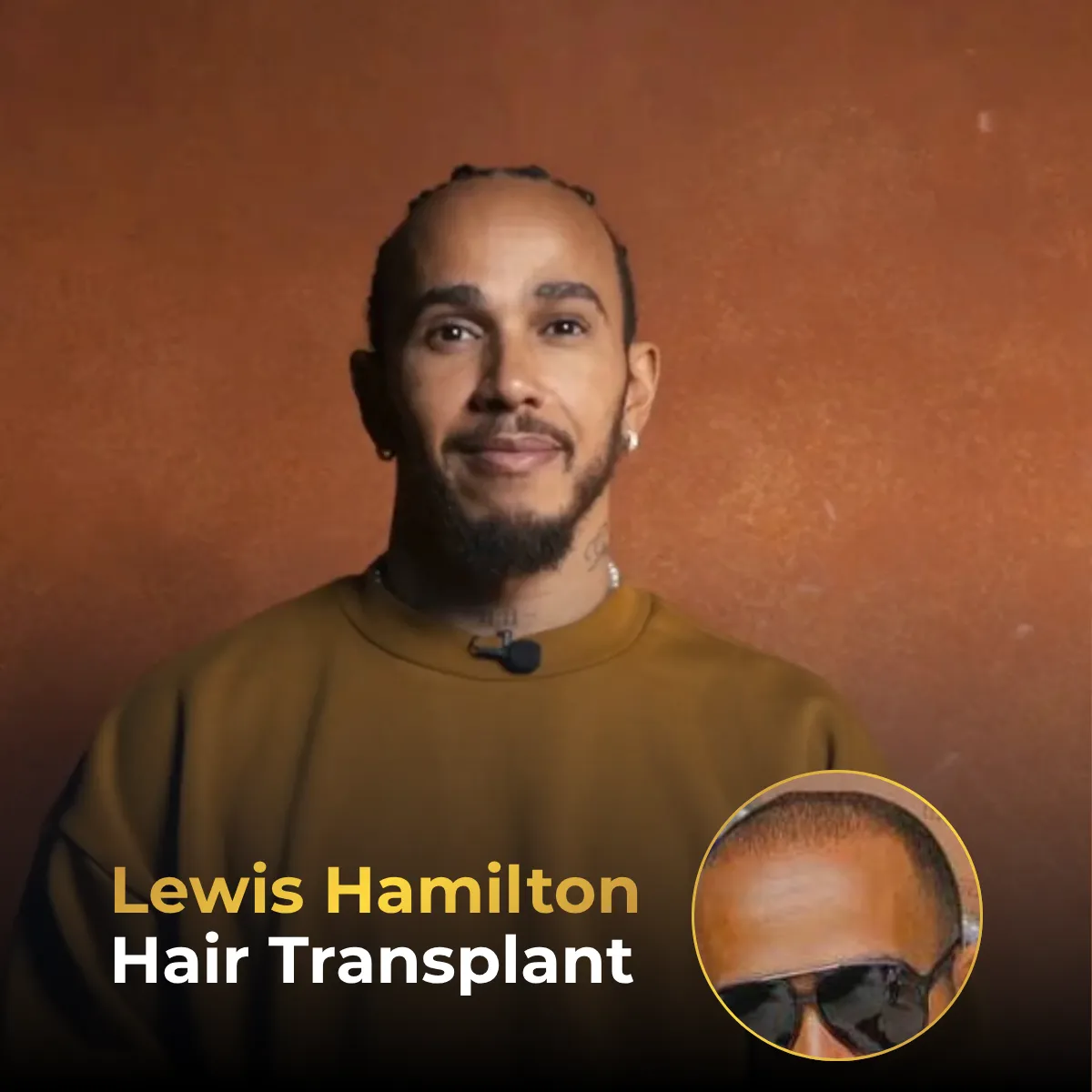 Lewis Hamilton hair transplant, Lewis Hamilton before after, Lewis Hamilton hairline analysis, celebrity hair transplant, hair restoration rumors, hair density change