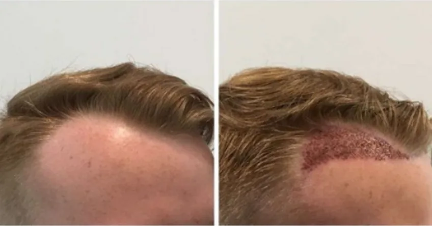 Side view of a man with light-coloured hair: a receding temple before surgery, and the same temple covered in small red graft sites right after grafting