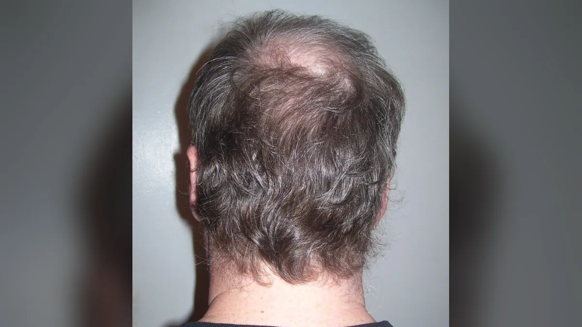 Back view of a man's head with thinning hair at the crown