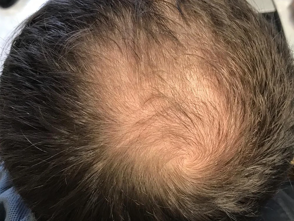 Top of a man's head seen from above, with thinning hair and visible scalp at the crown