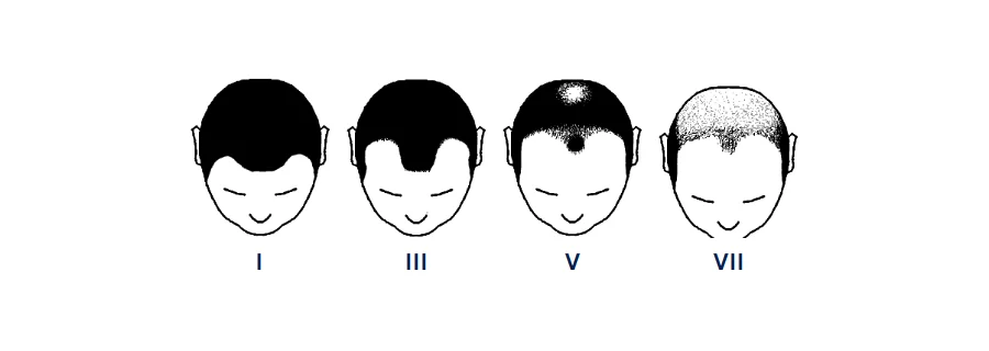 Drawings of the head from above at stages I, III, V and VII of male pattern baldness, from a full hairline to a horseshoe of hair at the sides and back