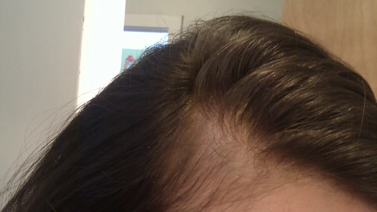 Close-up of the temple area of a woman's head, with dark hair swept back and thinner hair along the front hairline
