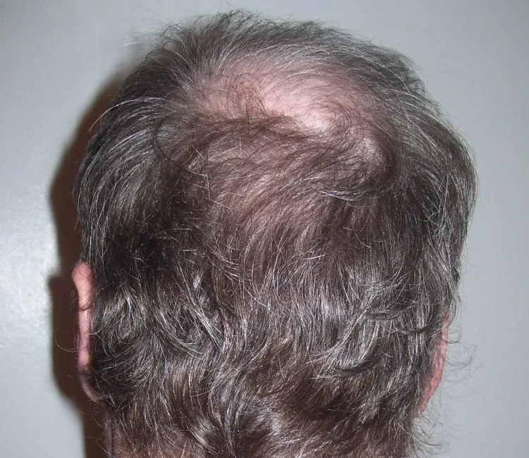 Back of a man's head with thinning hair at the crown