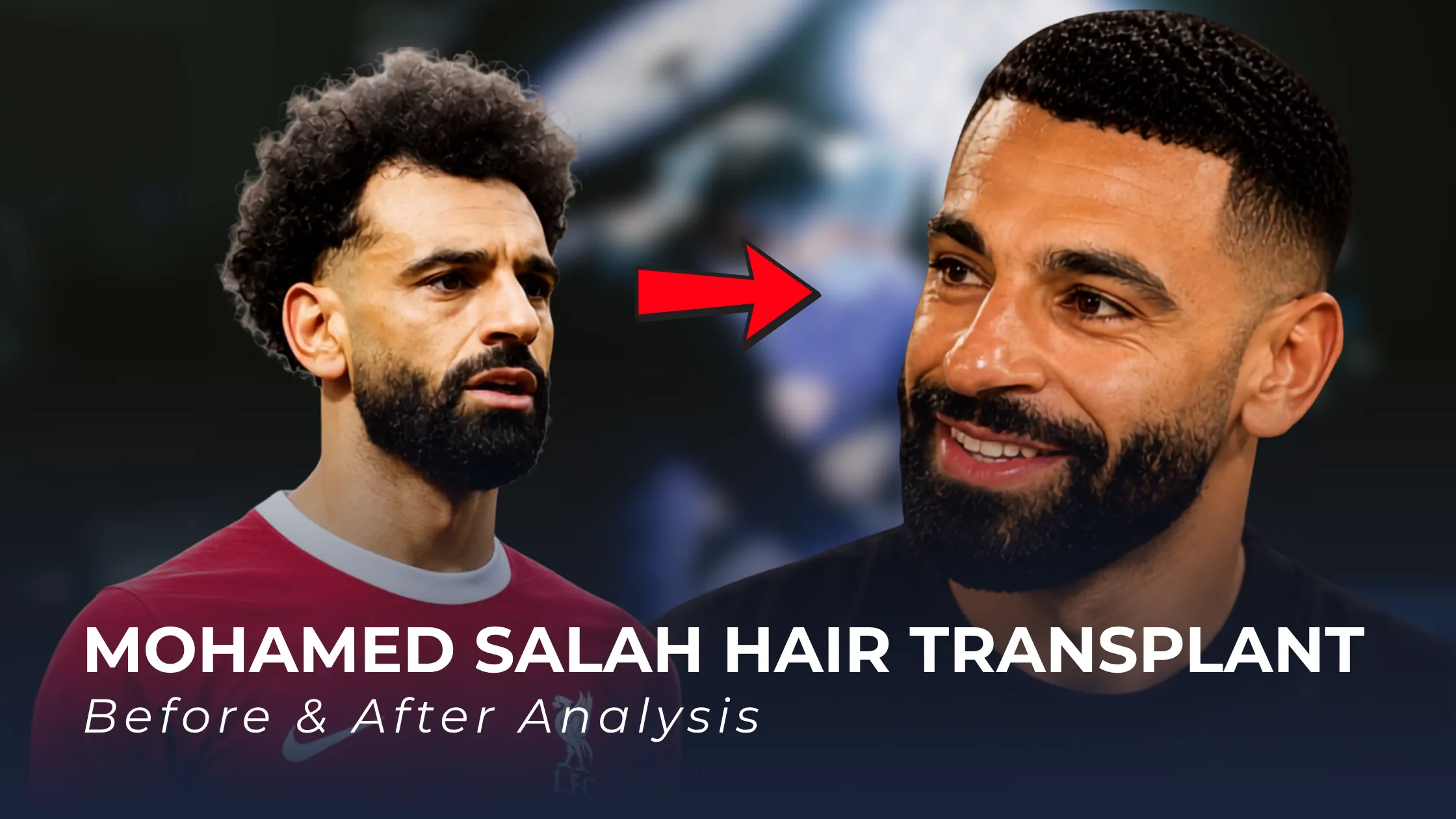 Mohamed Salah hair transplant, Mohamed Salah before after, Mohamed Salah hairline analysis, footballer hair transplant, celebrity hair restoration, hair loss analysis