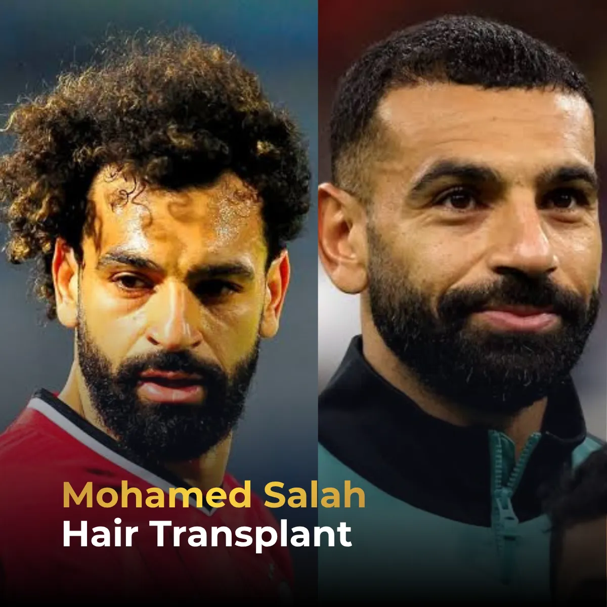 Mohamed Salah hairline analysis, Mohamed Salah hair transplant, footballer hair restoration, celebrity hairline change, hair density analysis, before after hairline
