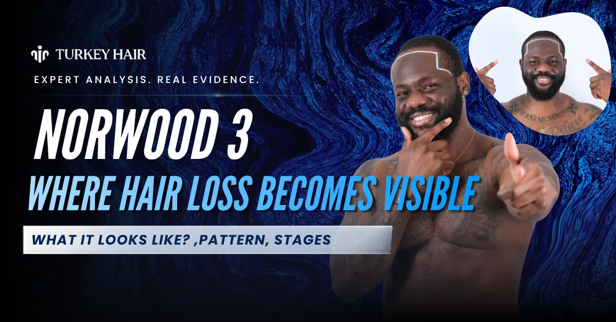 Norwood 3 Hair Loss, Norwood 3, Male Pattern Baldness, Hair Loss Stages