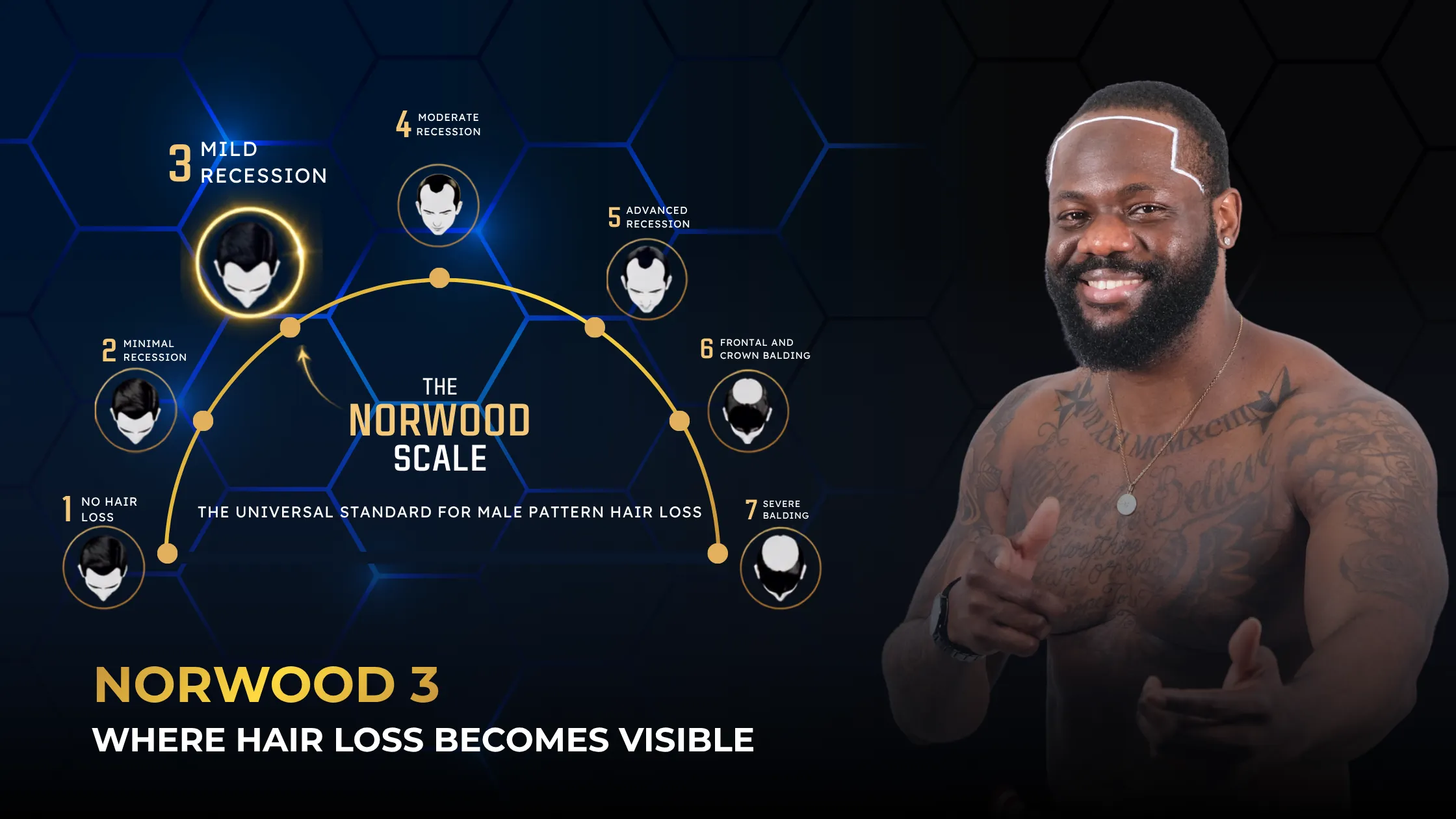 Norwood 3 Hair Loss, Norwood Scale, Male Pattern Baldness, Hair Thinning