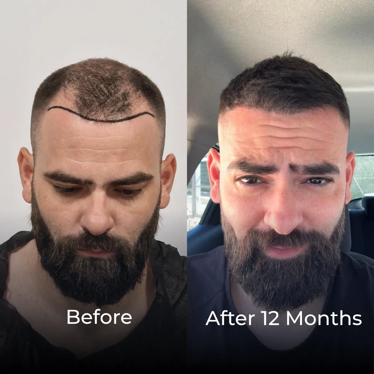 Norwood 3 Hair Transplant Before After, 12 Month Hair Transplant, Hair Restoration Results, Norwood 3 Results