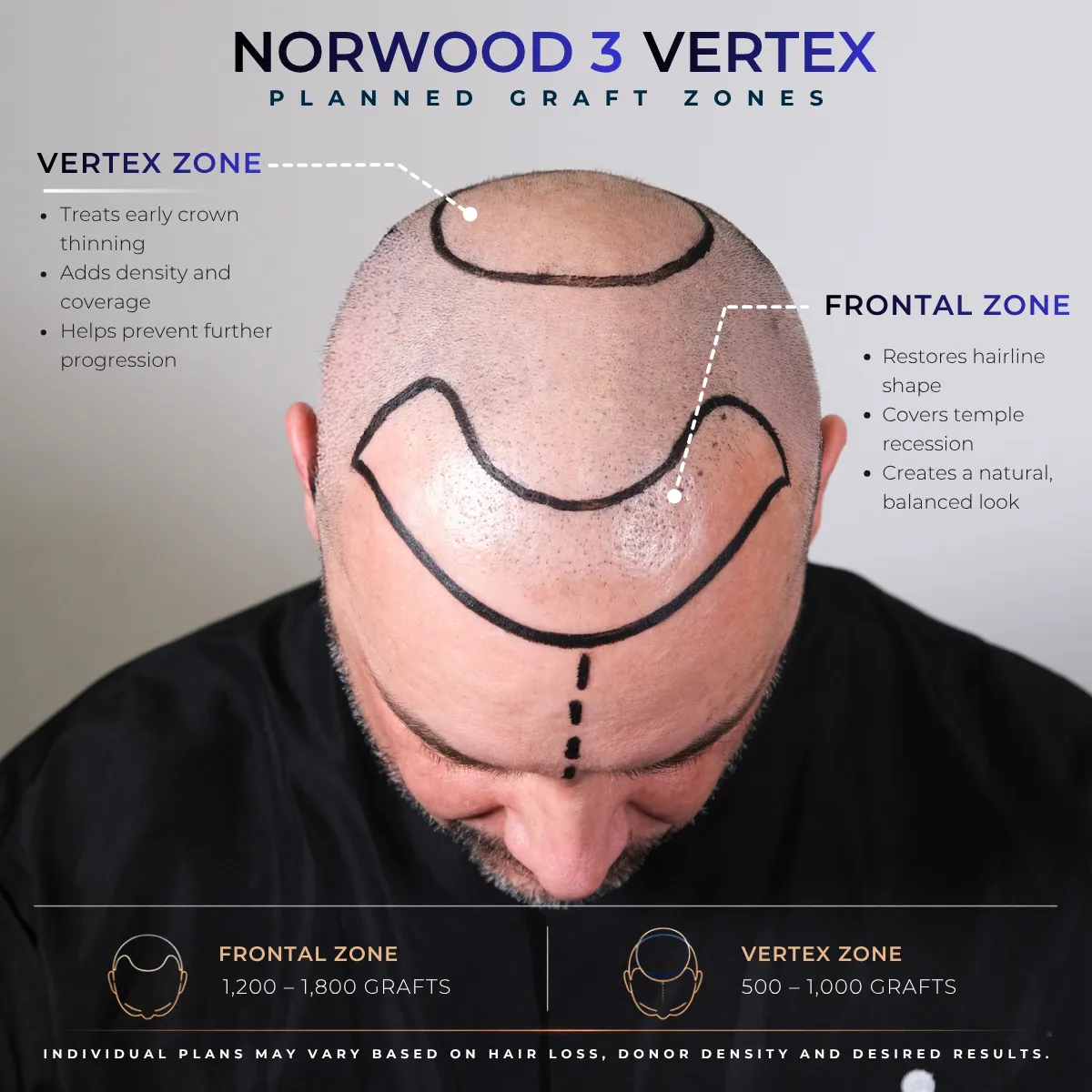 Norwood Scale 3: When Hair Loss Becomes Visible